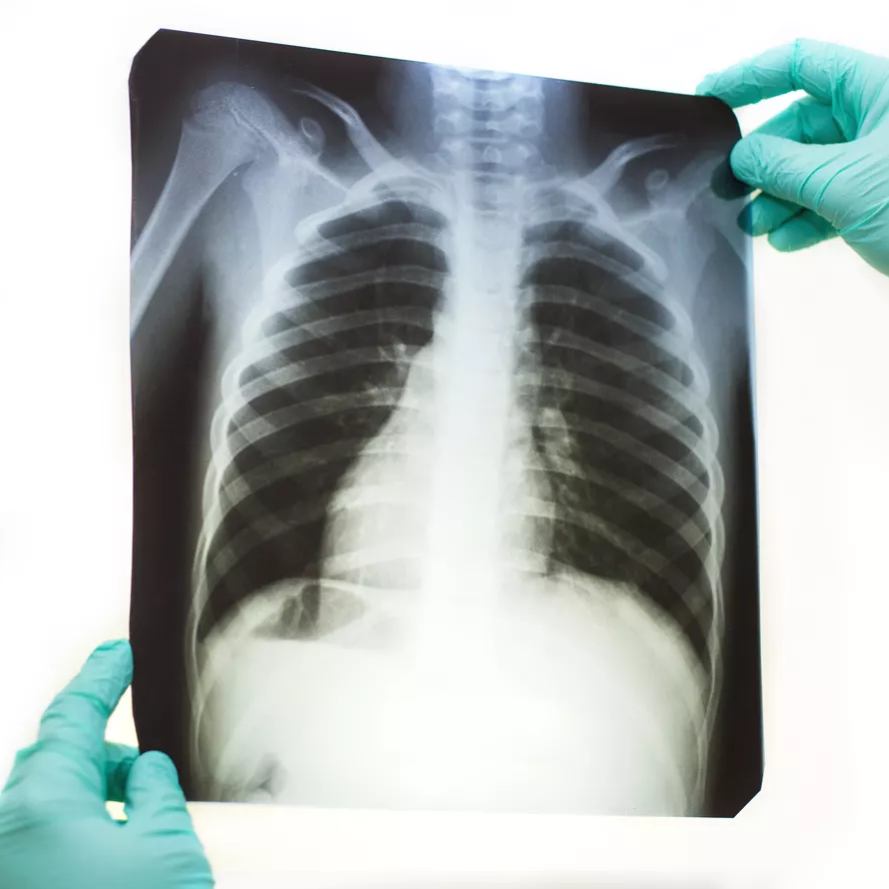 radiography-chest-x-ray