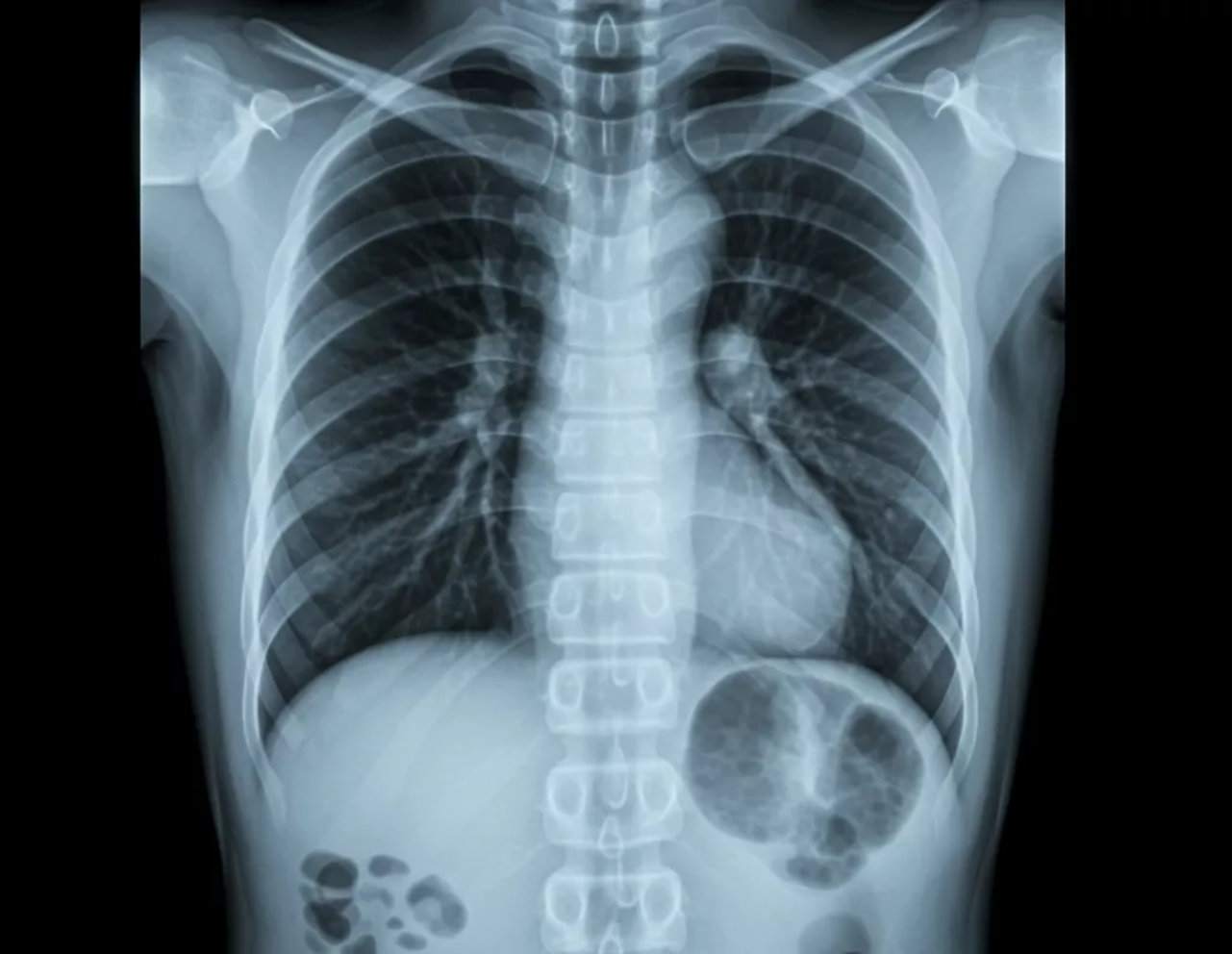 ​Heart Size and Shape