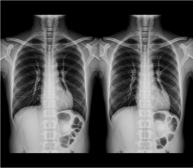 chest x ray normal vs abnormal